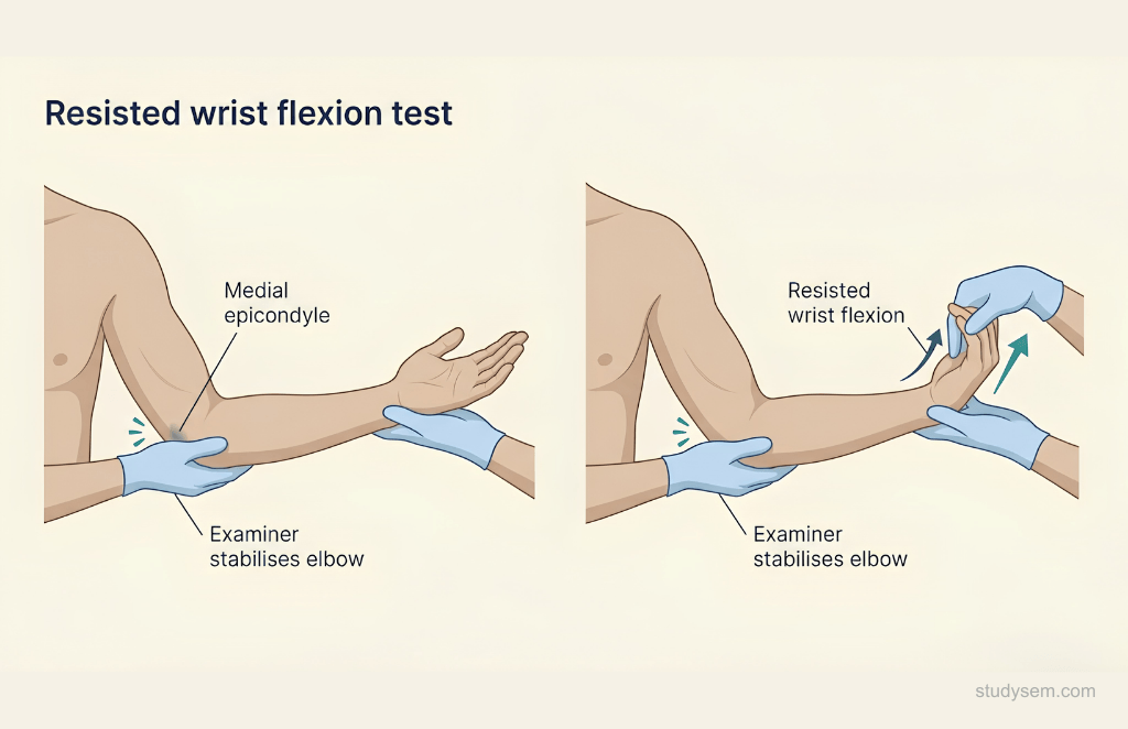 Resisted wrist flexion test for medial epicondylalgia showing pain at the medial epicondyle with elbow extended and forearm supinated.