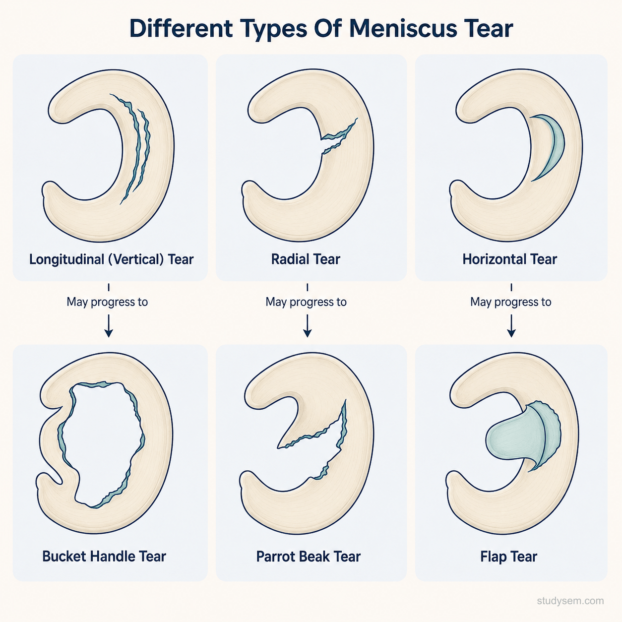 Six common meniscal tear patterns shown from above: longitudinal, bucket-handle, radial, horizontal cleavage, flap, and complex degenerative