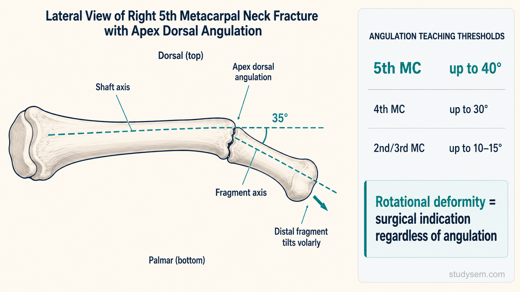 Lateral view of a 5th metacarpal neck fracture showing apex dorsal angulation with thresholds for conservative management by metacarpal and rotational deformity as a surgical indication.