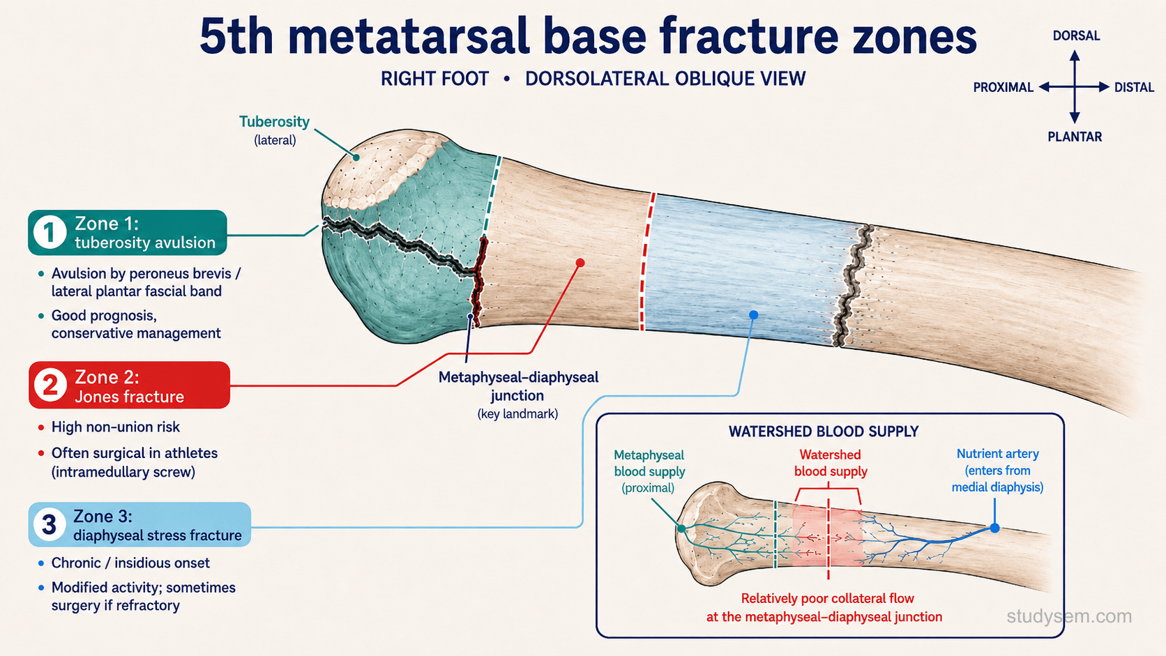 Proximal 5th metatarsal diagram showing three fracture zones: Zone 1 tuberosity avulsion with good prognosis, Zone 2 Jones fracture at the metaphyseal-diaphyseal junction with high non-union risk, and Zone 3 diaphyseal stress fracture