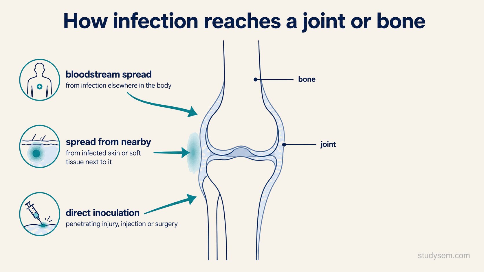A schematic showing the three routes by which infection reaches a joint or bone: haematogenous spread through the bloodstream from a distant infection, direct spread from adjacent infected skin or soft tissue, and direct inoculation from penetrating trauma, a joint injection or surgery, all converging on a joint and bone.
