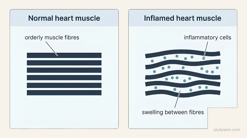 Two-panel schematic comparing normal heart muscle, with orderly fibres, against inflamed heart muscle in myocarditis, showing inflammatory cells and swelling between the fibres.
