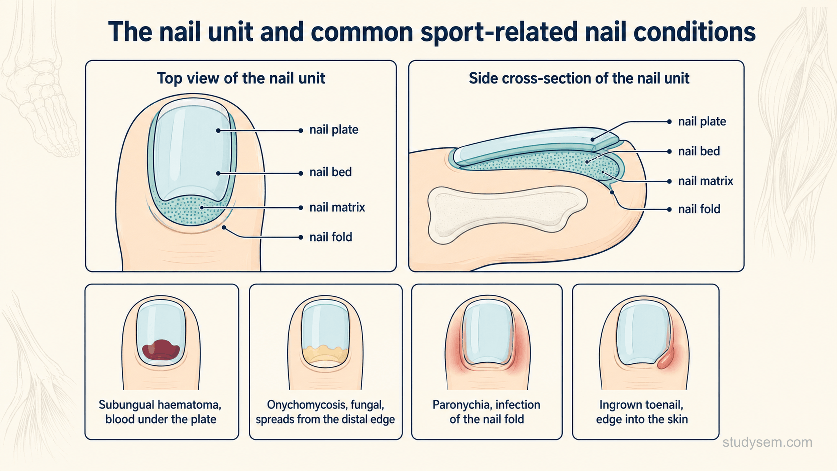 A clean labelled diagram on a cream background titled 'The nail unit and common sport-related nail conditions'. A cross-section and top view of a toenail label the nail plate, nail bed, nail matrix and nail fold. Around it, four neat call-outs point to where common conditions occur: 'subungual haematoma, blood under the plate', 'onychomycosis, fungal infection from the distal edge', 'paronychia, infection of the nail fold', and 'ingrown toenail, edge penetrating the skin'. Understated engraving style at low opacity.