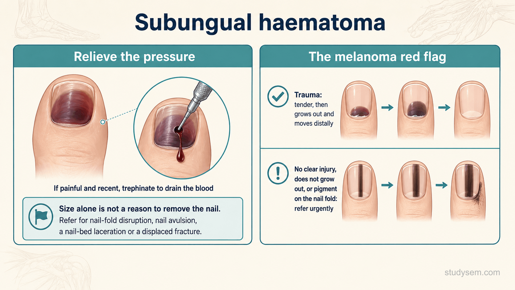 A clean two-part diagram on a cream background titled 'Subungual haematoma'. Left panel 'Relieve the pressure': an acutely painful haematoma under a nail with a note 'if painful and recent, trephinate to drain the blood'; a flag reads 'size alone is not a reason to remove the nail; refer for nail-fold disruption, avulsion, nail-bed laceration or a displaced fracture'. Right panel 'The melanoma red flag': a contrast between 'trauma, tender then grows out and moves distally' and 'no clear injury, does not grow out, or pigment on the nail fold, refer urgently'. Neutral bordered panels, no photographic detail.