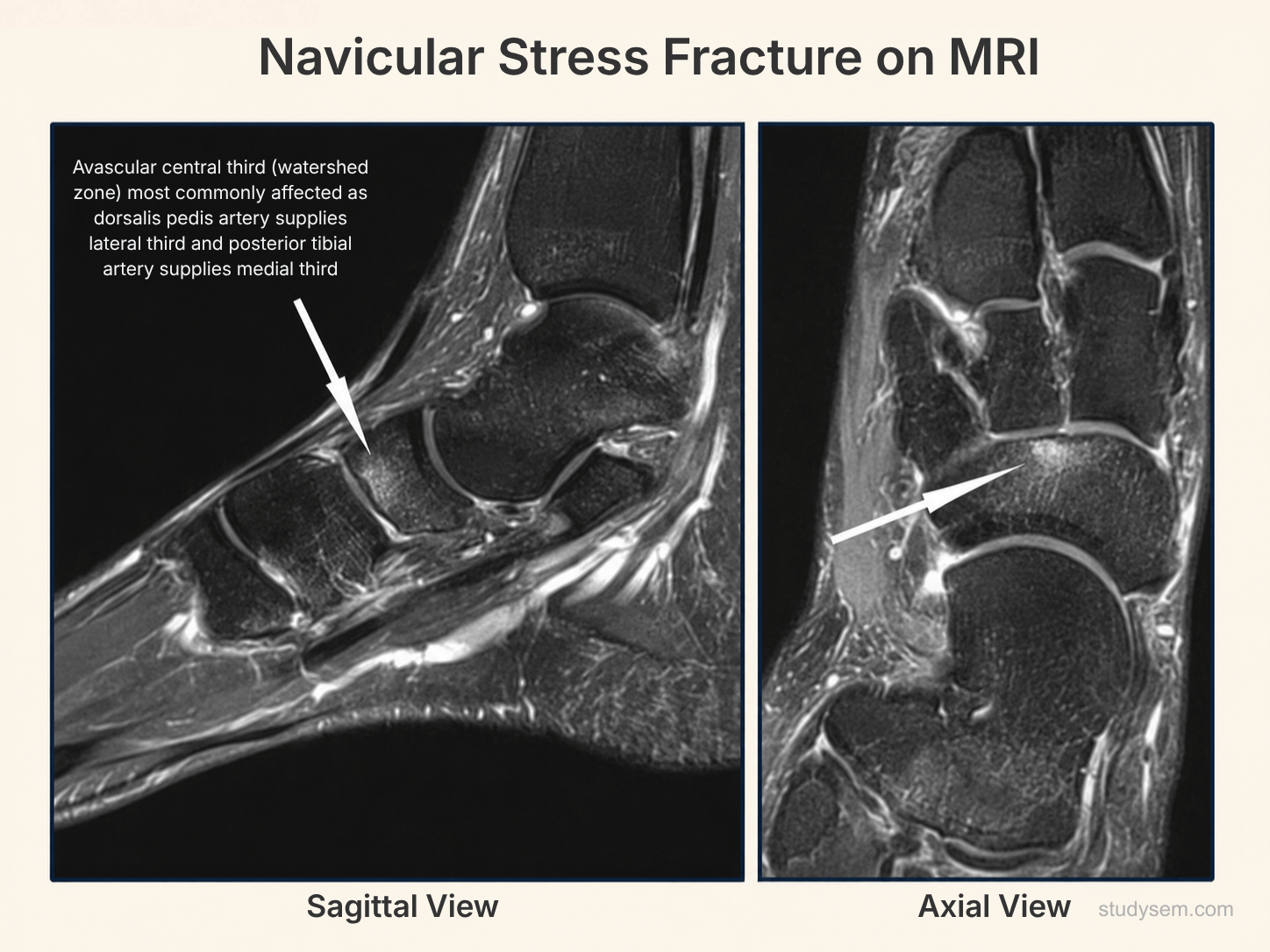 Coronal MRI of the navicular highlighting the avascular central third (watershed zone) where stress fractures classically occur, with the typical sagittal fracture line through this zone