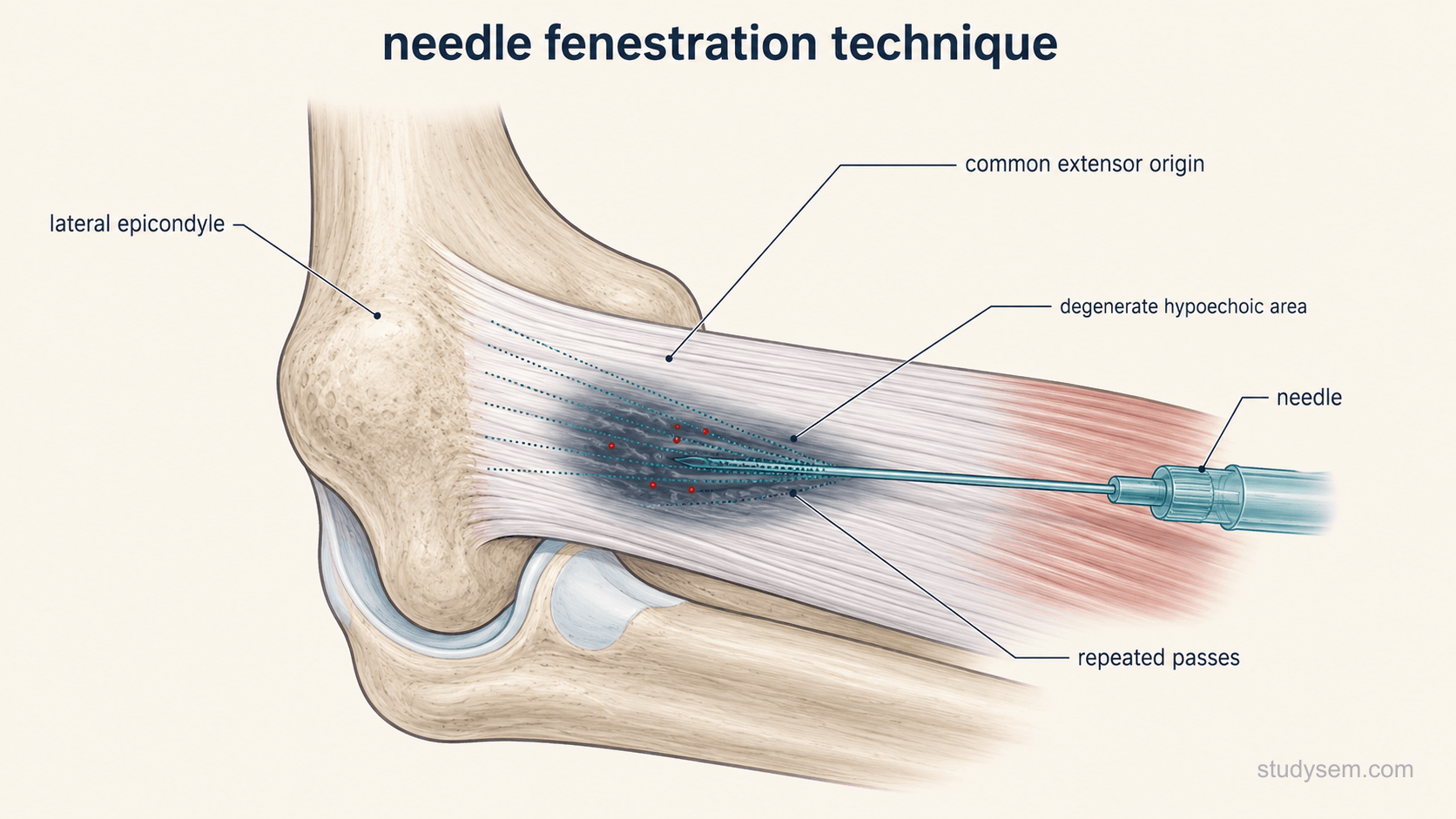 Anatomically accurate longitudinal section of the common extensor origin at the lateral epicondyle of the humerus, showing normal parallel collagen fibres proximally and a darker, disorganised hypoechoic degenerate area at the enthesis. A needle enters in-plane and is shown making several fanned passes through the degenerate area, with fine dotted lines marking previous passes and a few small red points indicating bleeding induced within the lesion. Labels only: lateral epicondyle, common extensor origin, degenerate hypoechoic area, needle, repeated passes.