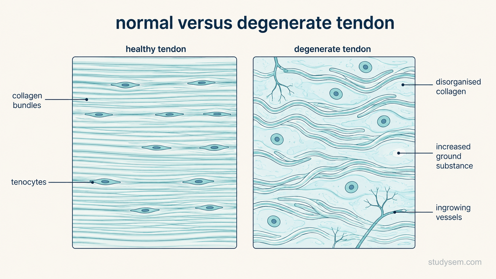 Two side-by-side magnified panels of tendon tissue on a cream background. The left panel, labelled healthy tendon, shows tightly packed parallel collagen bundles with sparse elongated tenocytes lying in rows between them. The right panel, labelled degenerate tendon, shows disorganised wavy collagen with wider separation between bundles, increased ground substance shown as pale filling, rounded rather than elongated cells, and a few fine vessels entering. Labels only: collagen bundles, tenocytes, disorganised collagen, increased ground substance, ingrowing vessels.