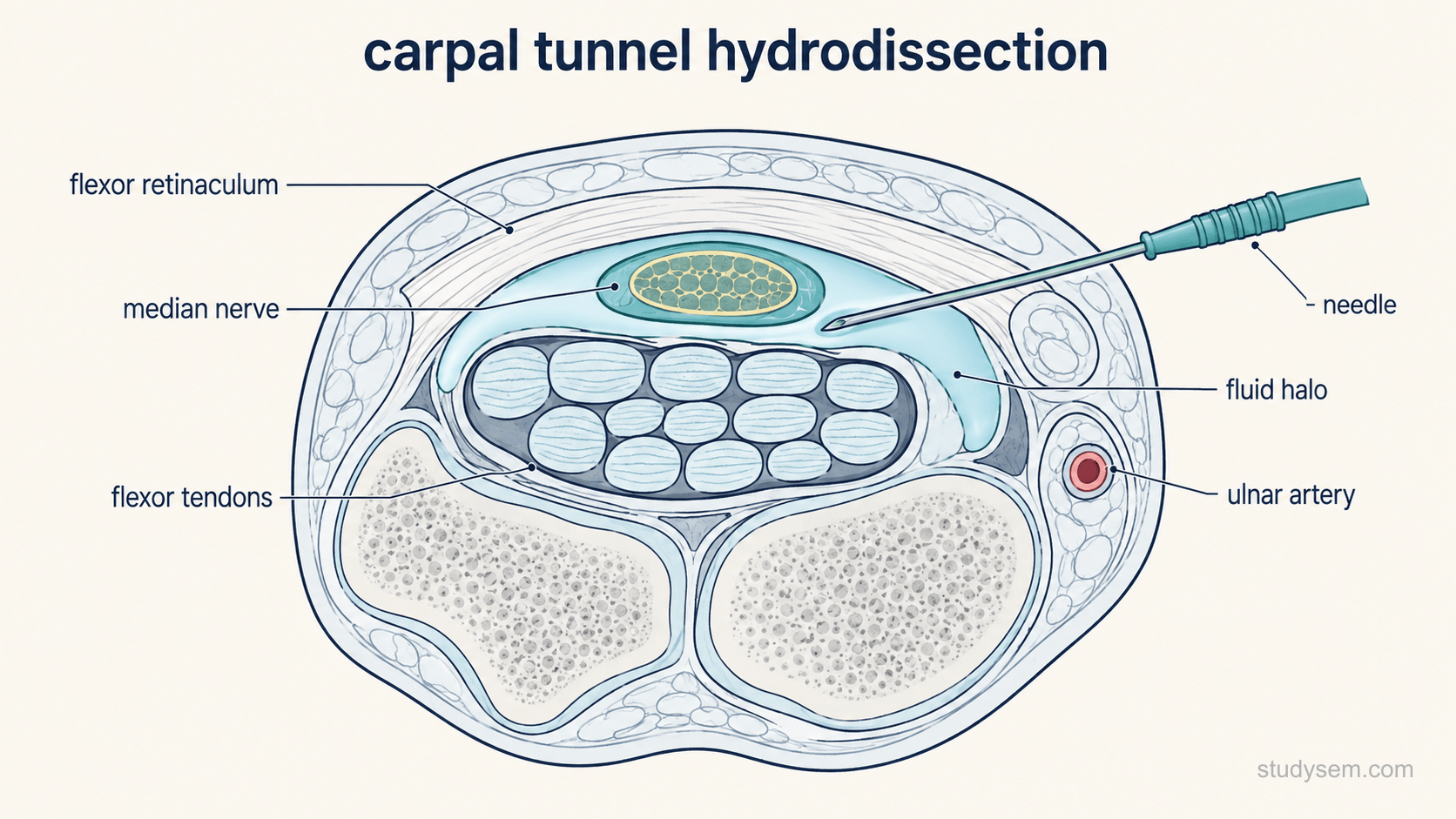Anatomically accurate transverse cross-section of the carpal tunnel at the level of the pisiform and scaphoid, showing the flexor retinaculum roofing the tunnel, the flexor tendons within it, the median nerve lying superficially and radially beneath the retinaculum, and the ulnar artery and nerve outside the tunnel in Guyon's canal. A needle enters in-plane from the ulnar side, passing above the flexor tendons, and an anechoic halo of injected fluid is shown lifting the median nerve away from both the retinaculum above and the tendons below. Labels only: flexor retinaculum, median nerve, flexor tendons, ulnar artery, needle, fluid halo.
