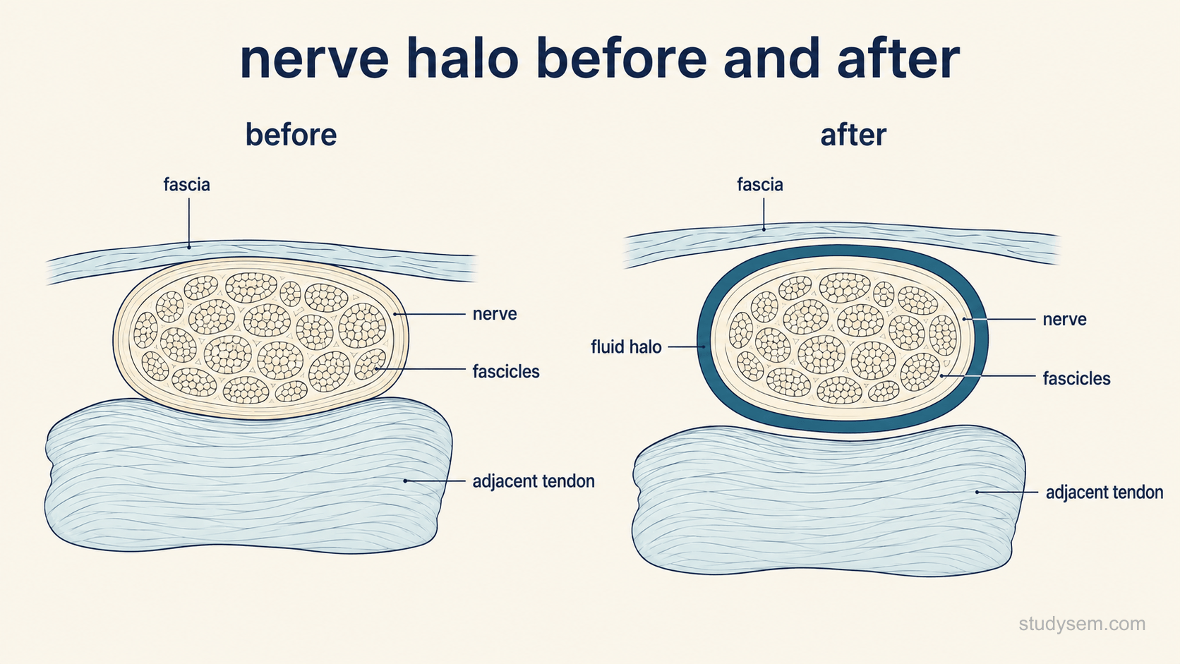 Two side-by-side transverse cross-sections of the same nerve on a cream background. The left panel, labelled before, shows the nerve with its normal honeycomb fascicular pattern lying flattened and directly against the adjacent tendon and overlying fascia, with no plane between them. The right panel, labelled after, shows the same nerve lifted away and surrounded by a continuous dark rim of fluid separating it from both structures. Labels only: nerve, fascicles, adjacent tendon, fascia, fluid halo.