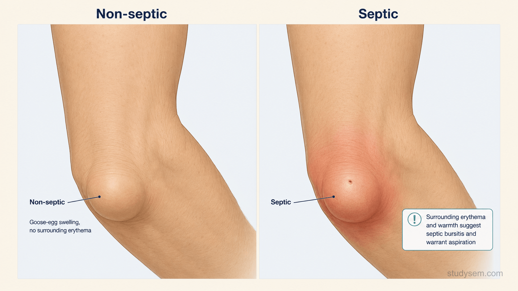 Comparison of aseptic olecranon bursitis showing isolated swelling and septic olecranon bursitis showing surrounding erythema and warmth.