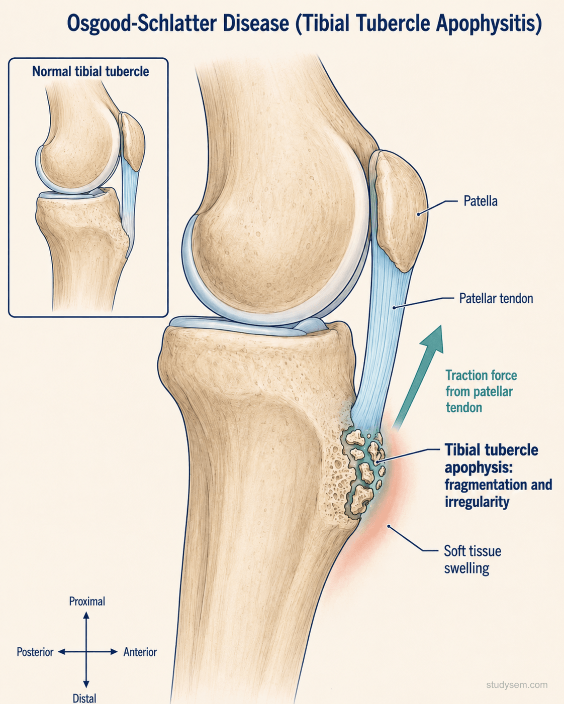 AI-generated lateral knee diagram showing Osgood-Schlatter disease with fragmentation and irregularity of the tibial tubercle apophysis from repeated patellar tendon traction