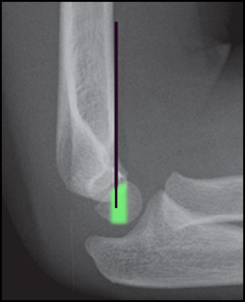 Lateral elbow radiograph of a young child with the anterior humeral line drawn down the anterior cortex of the humerus. The line passes through the middle third of the capitellum, which is highlighted; this is the normal finding. A line that falls anterior to this zone indicates a posteriorly displaced extension-type supracondylar fracture.