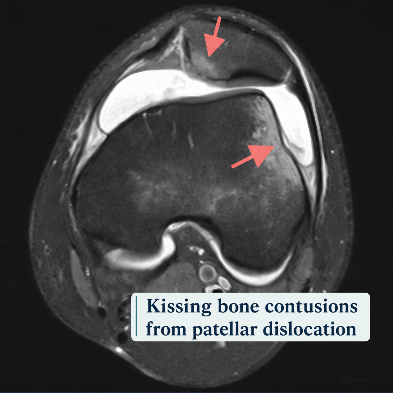 AI-generated axial MRI showing bone bruises on the medial patella and lateral femoral condyle in a kissing contusion pattern after lateral patellar dislocation