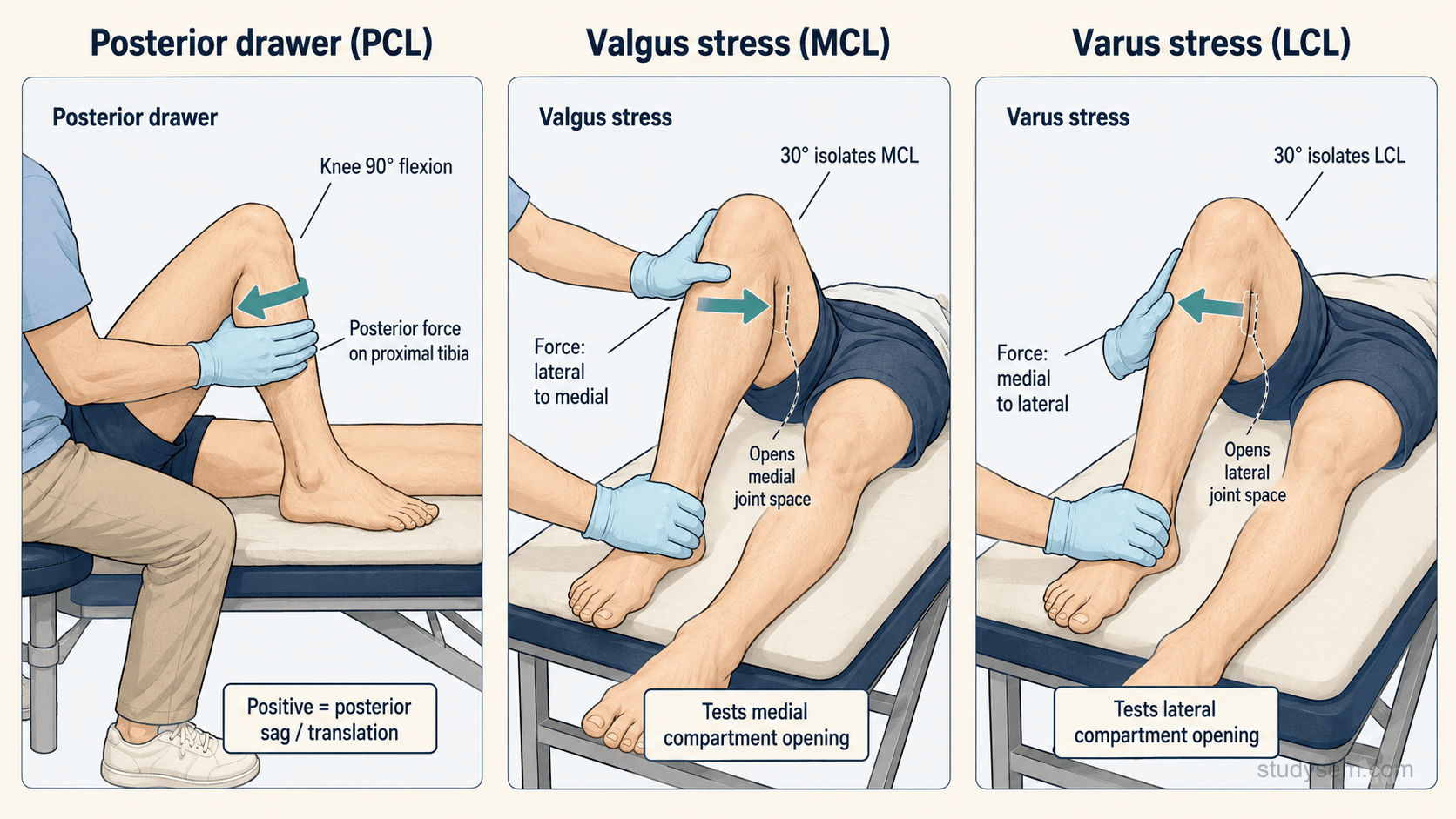 Three-panel examination diagram showing posterior drawer test for PCL, valgus stress test for MCL, and varus stress test for LCL all at 30 degrees knee flexion