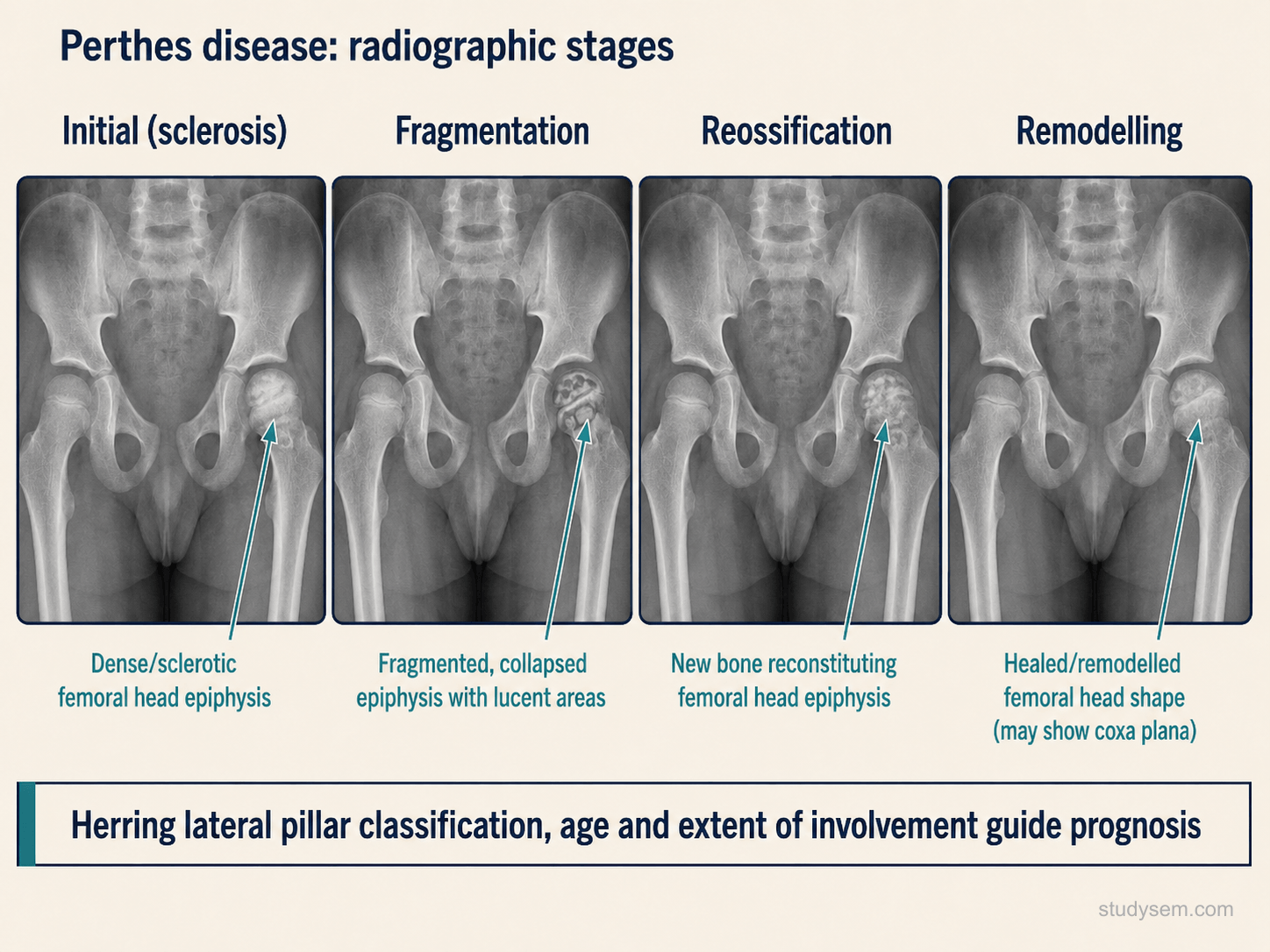 Four-panel paediatric AP pelvis radiograph diagram showing the Waldenström stages of Perthes disease: initial sclerosis of the capital femoral epiphysis with relative increased density; fragmentation with epiphyseal lucencies and femoral head flattening; reossification with progressive new bone formation; and remodelling with residual deformity (coxa plana, coxa magna). Caption notes the Catterall and Herring lateral pillar classifications applied during fragmentation guide prognosis.
