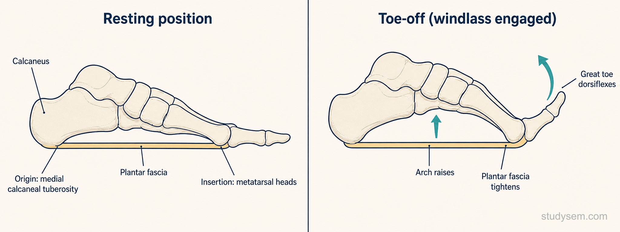 Medial sagittal view of the right foot showing the plantar fascia originating at the medial calcaneal tuberosity and fanning to the metatarsal heads, with the windlass mechanism illustrated in resting and toe-off positions