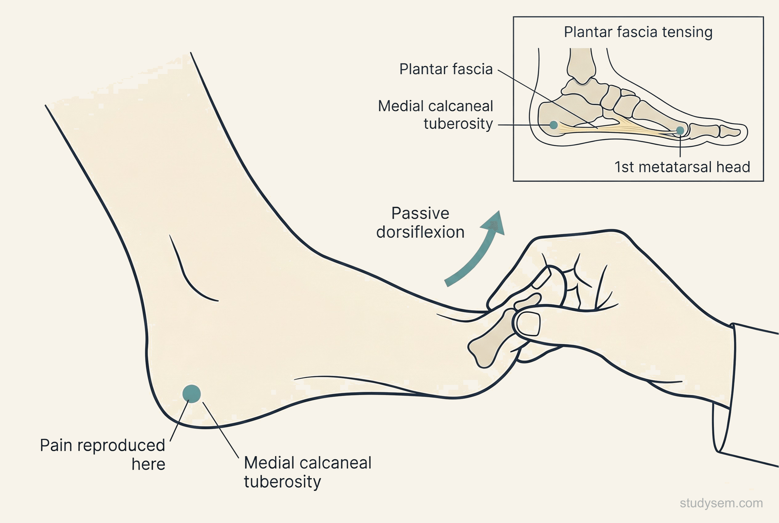 Illustration of the windlass test - the clinician's hand grips the great toe and passively dorsiflexes the metatarsophalangeal joint, with the plantar fascia tensing across the medial longitudinal arch and pain reproduced at the medial calcaneal tuberosity