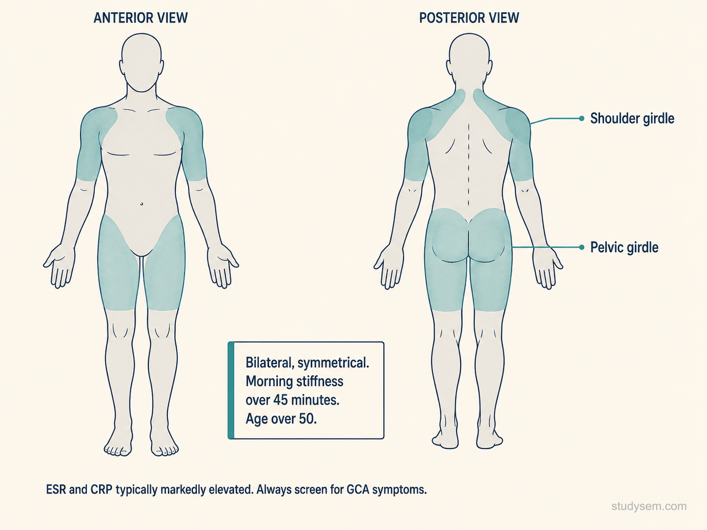 Anterior body schematic with shaded bilateral shoulder and pelvic girdle regions illustrating the symmetrical proximal pain distribution of polymyalgia rheumatica, with caption noting morning stiffness of over 45 minutes in a patient over 50