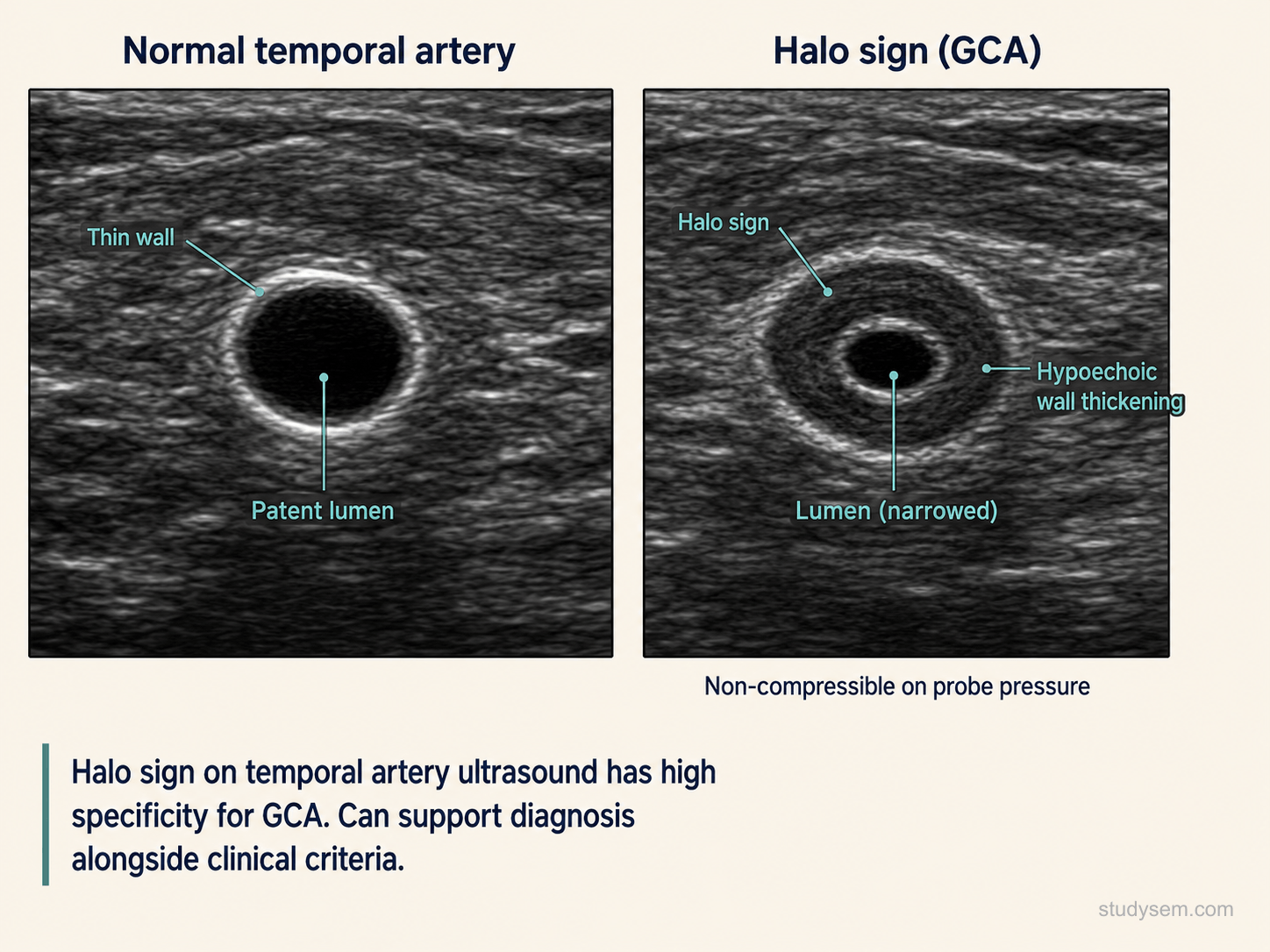 Temporal artery ultrasound longitudinal and transverse images demonstrating the halo sign, a hypoechoic concentric wall thickening surrounding the artery lumen, with the non-compressible artery on probe pressure - highly specific for giant cell arteritis