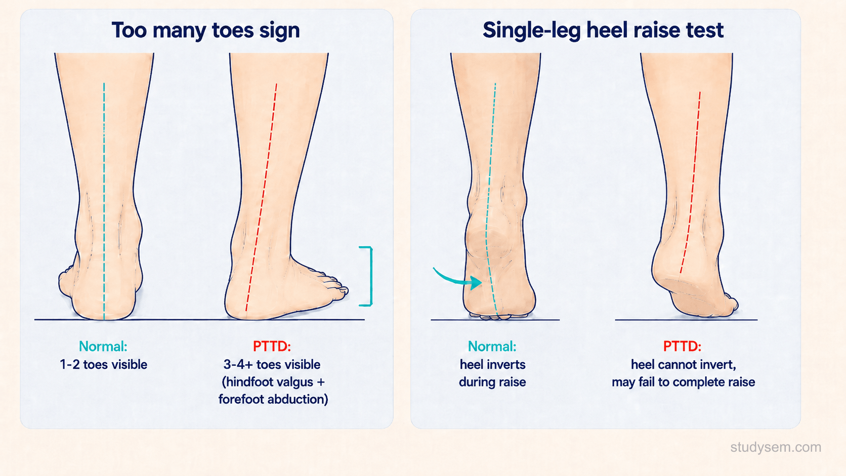 Two-panel examination diagram showing the too many toes sign from behind with hindfoot valgus and forefoot abduction on the left and failed single-leg heel raise with absent heel inversion on the right