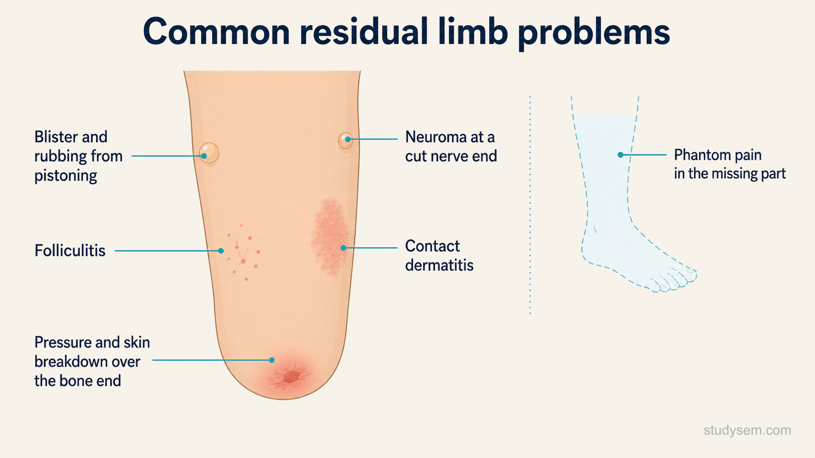 A labelled concept diagram of a lower-limb residual limb showing the common problems the clinician looks for: pressure marks and skin breakdown over the bone ends, a blister and rubbing from pistoning in the socket, folliculitis and contact dermatitis of the skin, and a tender neuroma at a cut nerve end, with a small inset indicating phantom pain felt in the missing part.