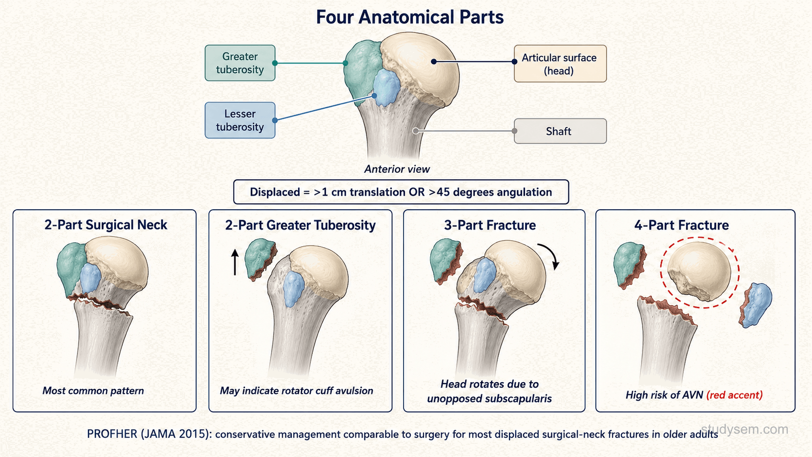 Diagram of the Neer 4-part classification of proximal humerus fractures.
