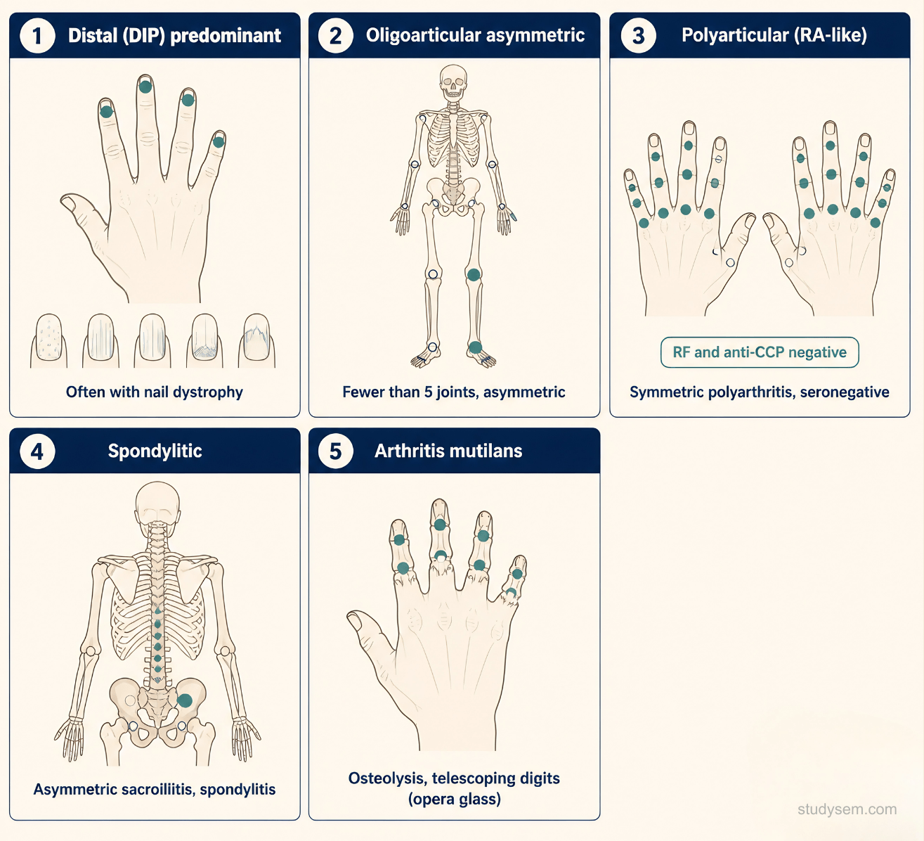 Five-panel diagram of the Moll and Wright psoriatic arthritis patterns: asymmetrical oligoarthritis with dactylitis, symmetrical polyarthritis resembling RA, DIP-predominant pattern with adjacent nail change, spondylitis with sacroiliitis, and arthritis mutilans with telescoping digits and pencil-in-cup deformity