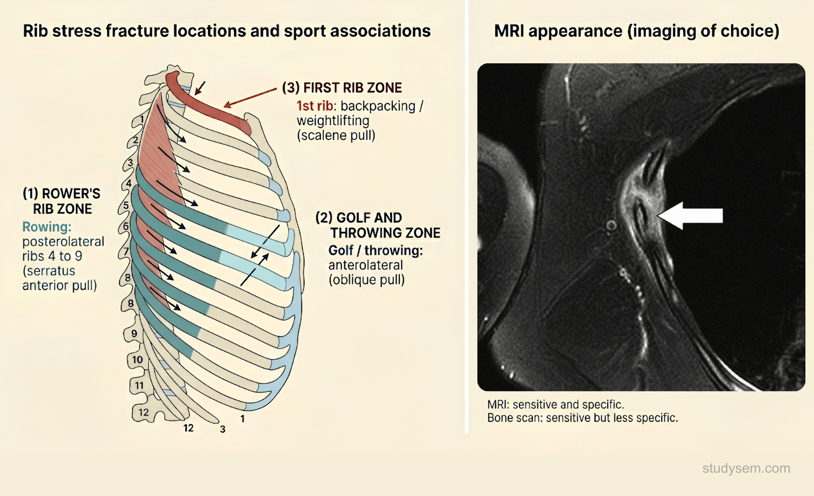 Posterolateral rib cage diagram showing the classic rower stress fracture distribution (4th to 9th ribs at the serratus anterior attachment) paired with MRI demonstrating bone marrow oedema and periosteal reaction