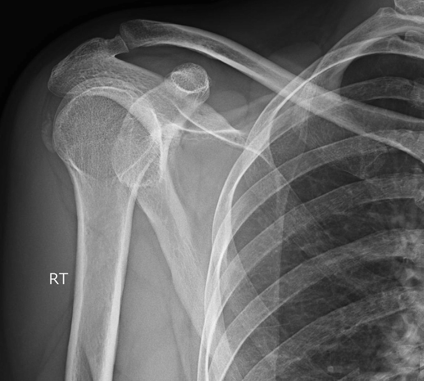 AP shoulder radiograph demonstrating a calcific deposit in the supraspinatus tendon.