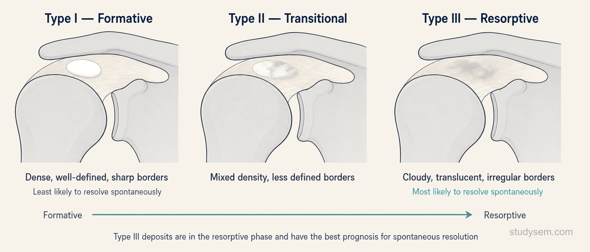 Gartner radiographic classification of calcific deposits Types I to III.