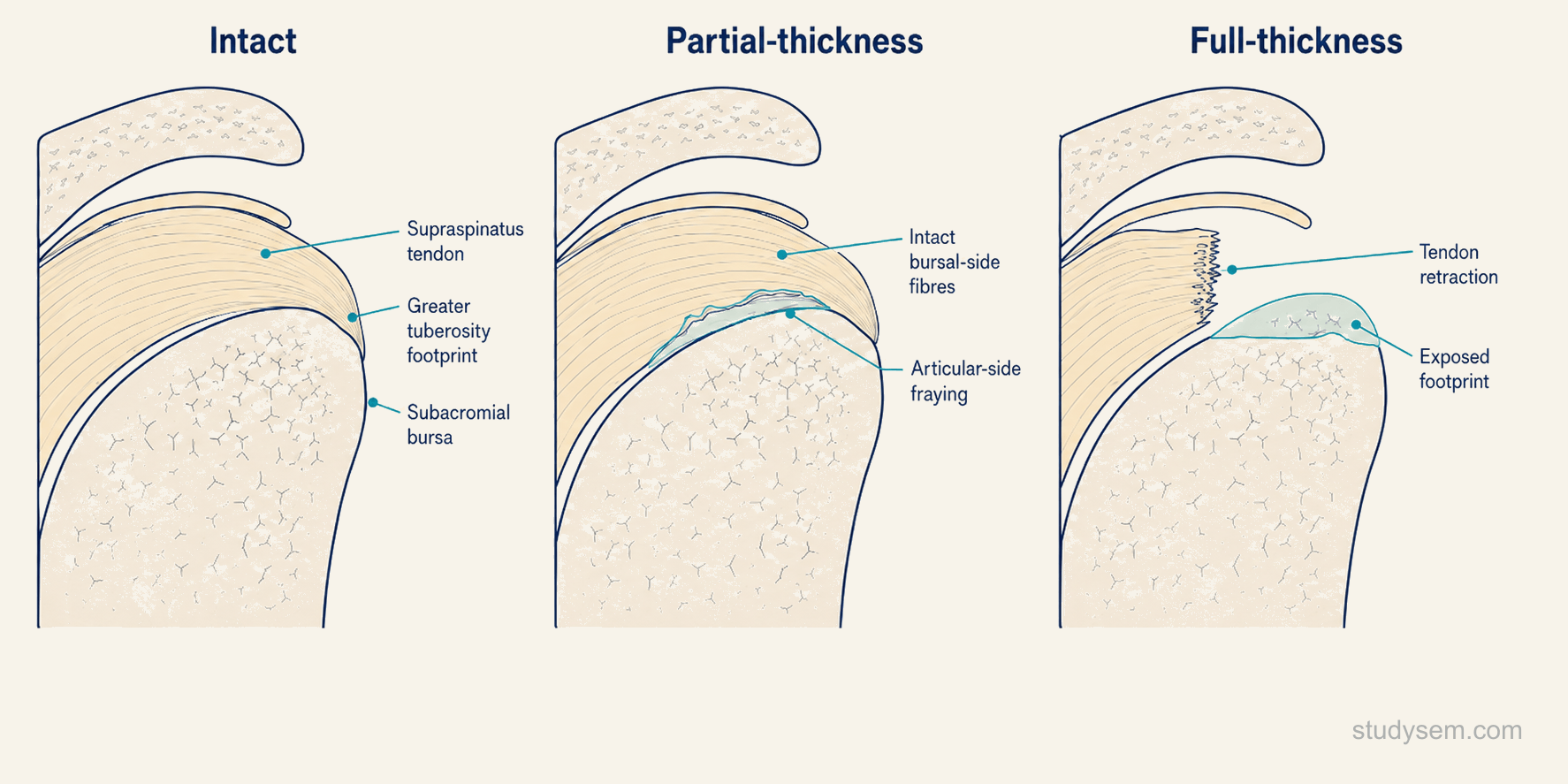 Three-panel cross-section comparison of rotator cuff tear morphology: articular-side partial-thickness tear at the supraspinatus footprint, bursal-side partial-thickness tear, and full-thickness tear with retraction of the tendon edge from the bony footprint.