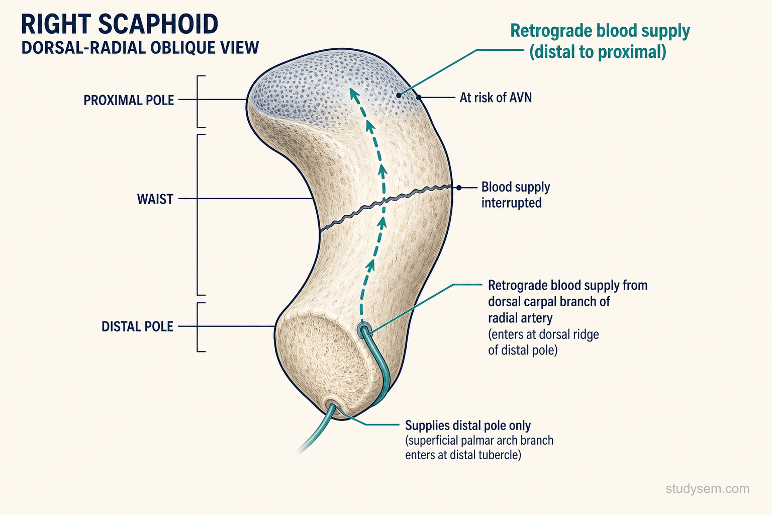Scaphoid bone showing retrograde blood supply from the dorsal carpal branch entering distally and running proximally with waist fracture line interrupting flow to the proximal pole.