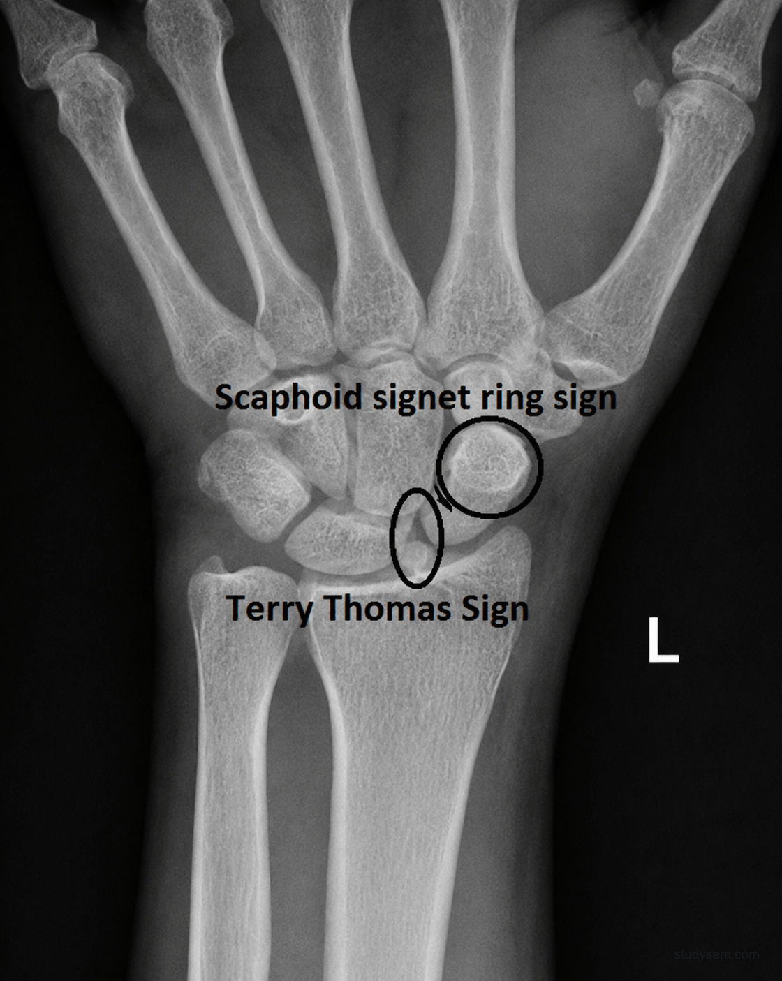 PA wrist radiograph showing Terry Thomas sign with scapholunate gap widened beyond 3 mm and signet ring sign from the cortical ring of the rotated scaphoid.