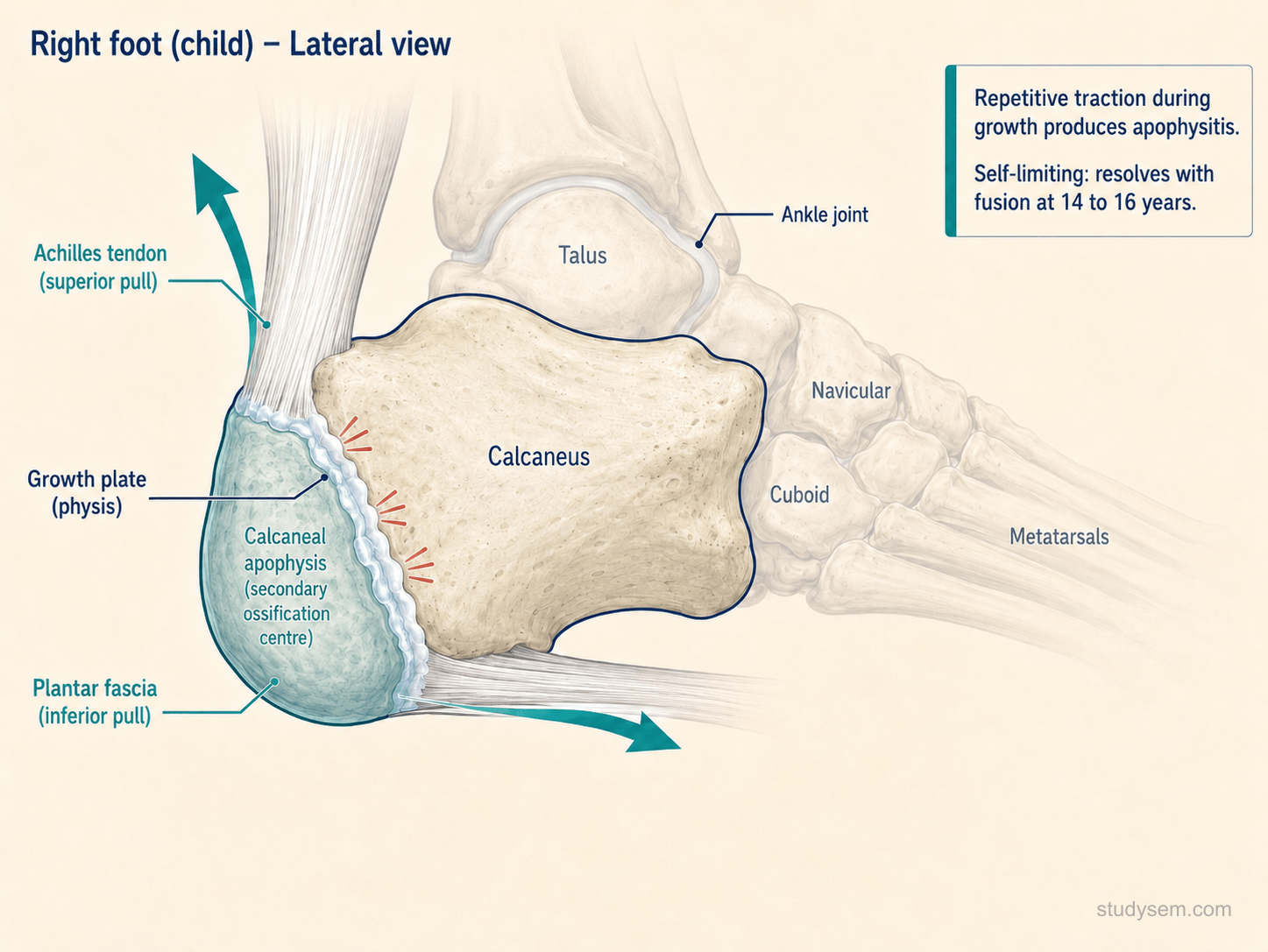 Lateral diagram of a paediatric foot and ankle showing the calcaneal secondary ossification centre (apophysis) at the posterior calcaneus. Achilles tendon insertion produces traction force on the apophysis; plantar fascia origin contributes to the local mechanical environment. Arrows depict repetitive traction during running and jumping and compressive heel-strike force. Caption notes the condition is self-limiting and resolves with apophyseal fusion at 14-16 years.
