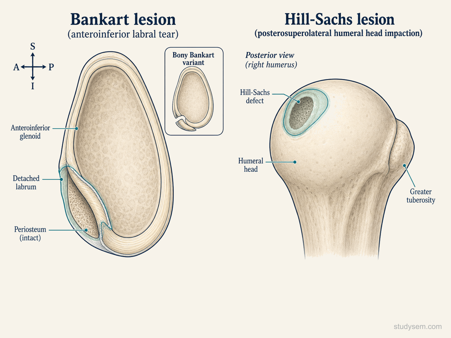 Two-panel comparative diagram of the bipolar lesion pattern after anterior glenohumeral dislocation: anteroinferior labral tear (Bankart lesion) and posterosuperolateral humeral head impaction (Hill-Sachs lesion).