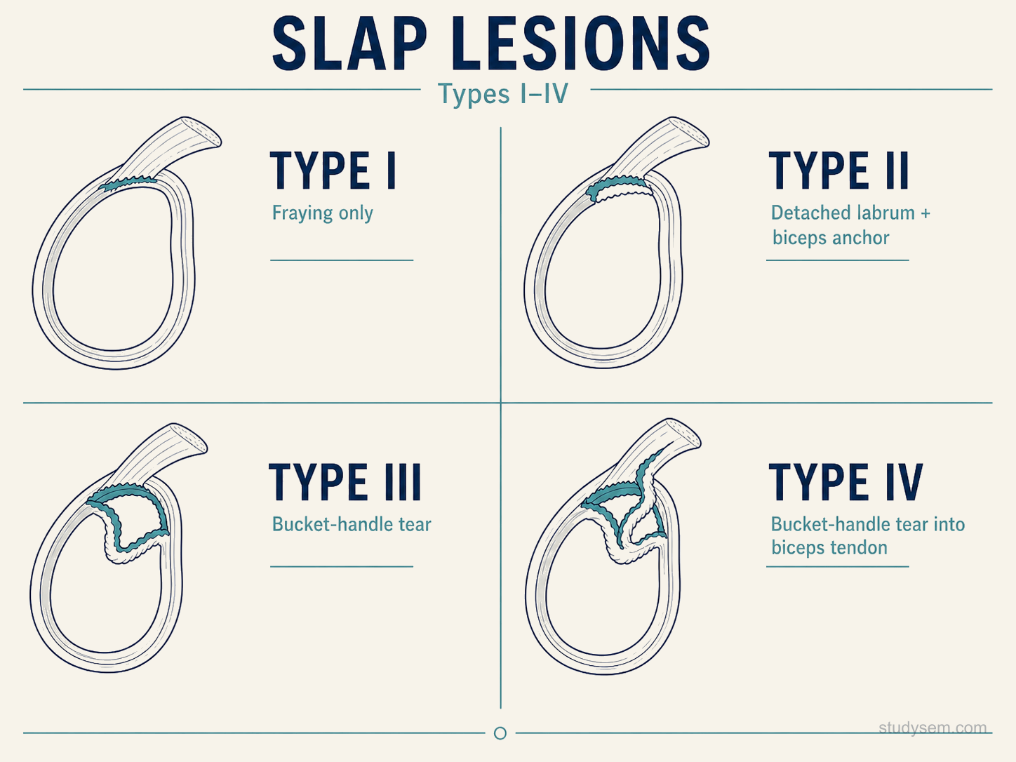 Anatomical diagram of the superior labrum and biceps anchor at the 12 o'clock position of the glenoid, illustrating how the long head of biceps tendon attaches into the labrum to form the biceps anchor disrupted in SLAP lesions.