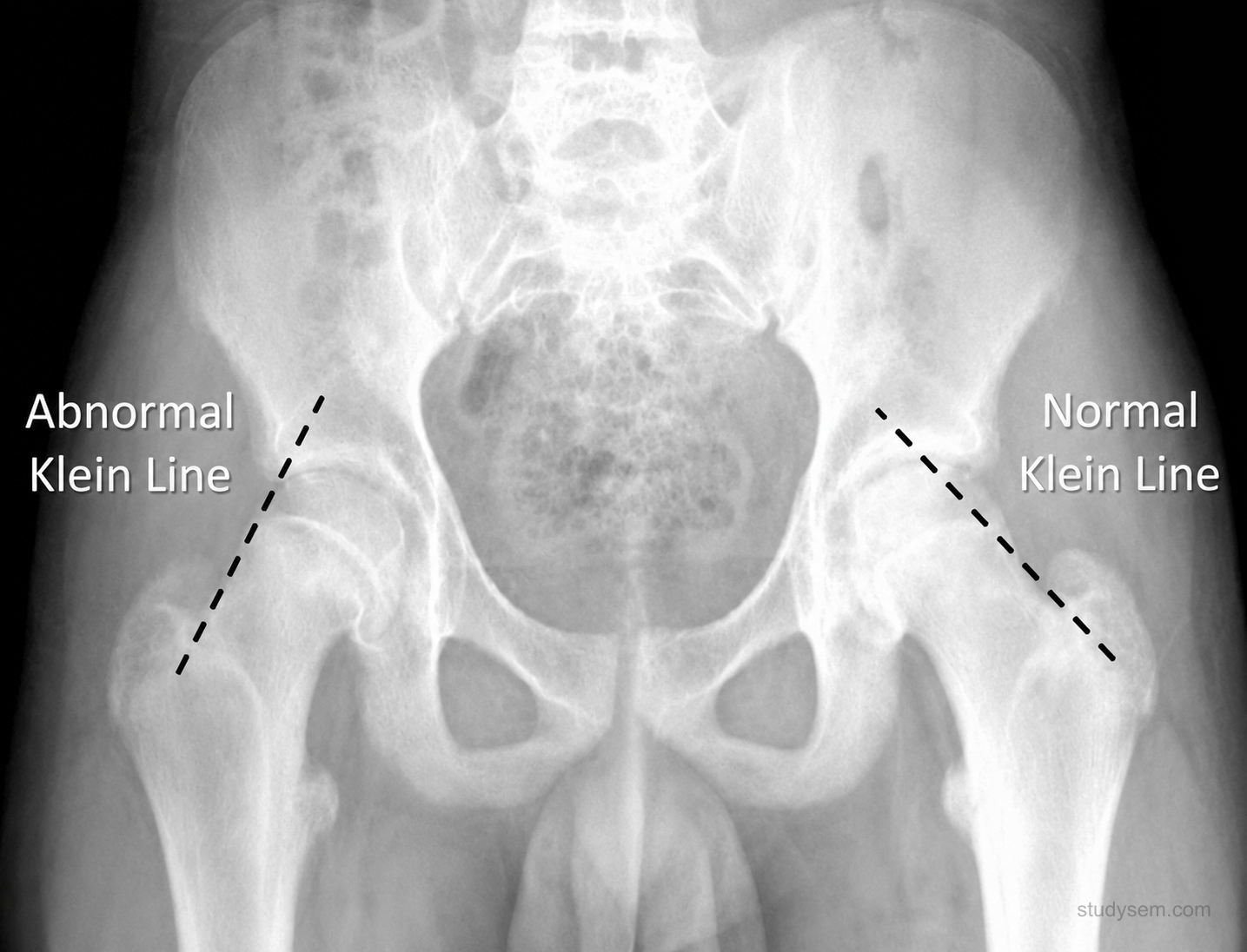 Frog-leg lateral hip radiograph in an adolescent demonstrating SUFE: posterior and inferior displacement of the capital femoral epiphysis through the physis, with Klein's line drawn along the superior border of the femoral neck failing to intersect the epiphysis (positive Trethowan's sign). Contralateral hip shown for comparison. Caption notes that the frog-leg lateral is more sensitive than AP for detecting the slip.
