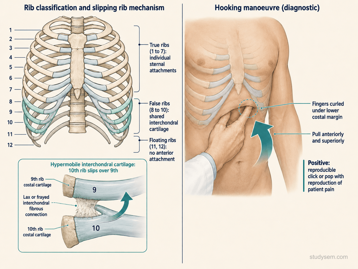 False ribs 8 to 10 showing the shared interchondral cartilage attachment to the rib above (rather than direct sternal articulation), paired with a diagram of the hooking manoeuvre reproducing rib tip subluxation, pain, and a click
