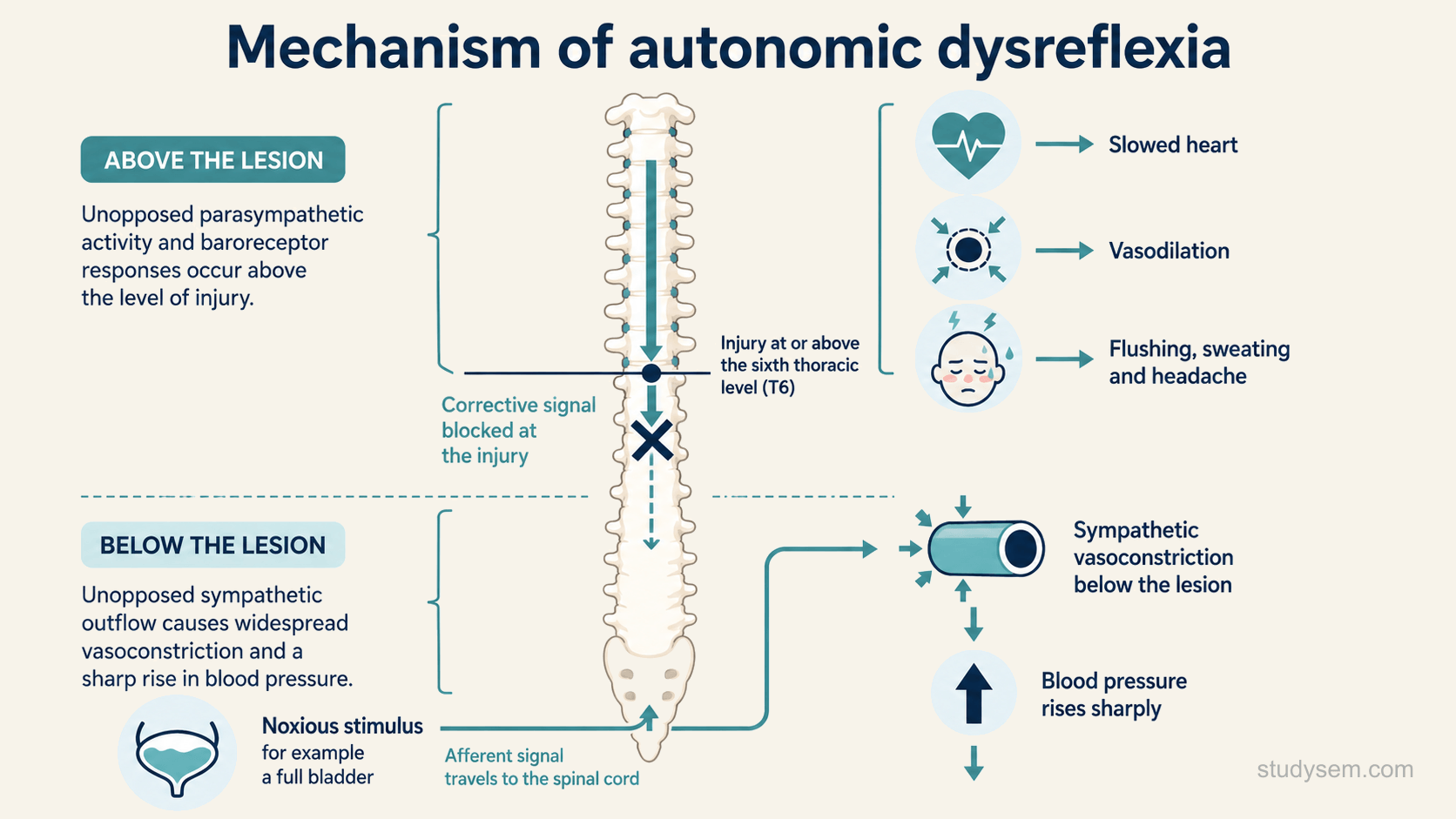 A concept figure of a simplified vertical spinal cord with a lesion marked at or above the sixth thoracic level, showing the mechanism of autonomic dysreflexia: below the lesion a noxious stimulus such as a full bladder drives sympathetic vasoconstriction and a sharp rise in blood pressure, while above the lesion baroreceptor reflexes produce a slowed heart, flushing and sweating, and the corrective descending signal is blocked at the level of injury so the hypertension persists.