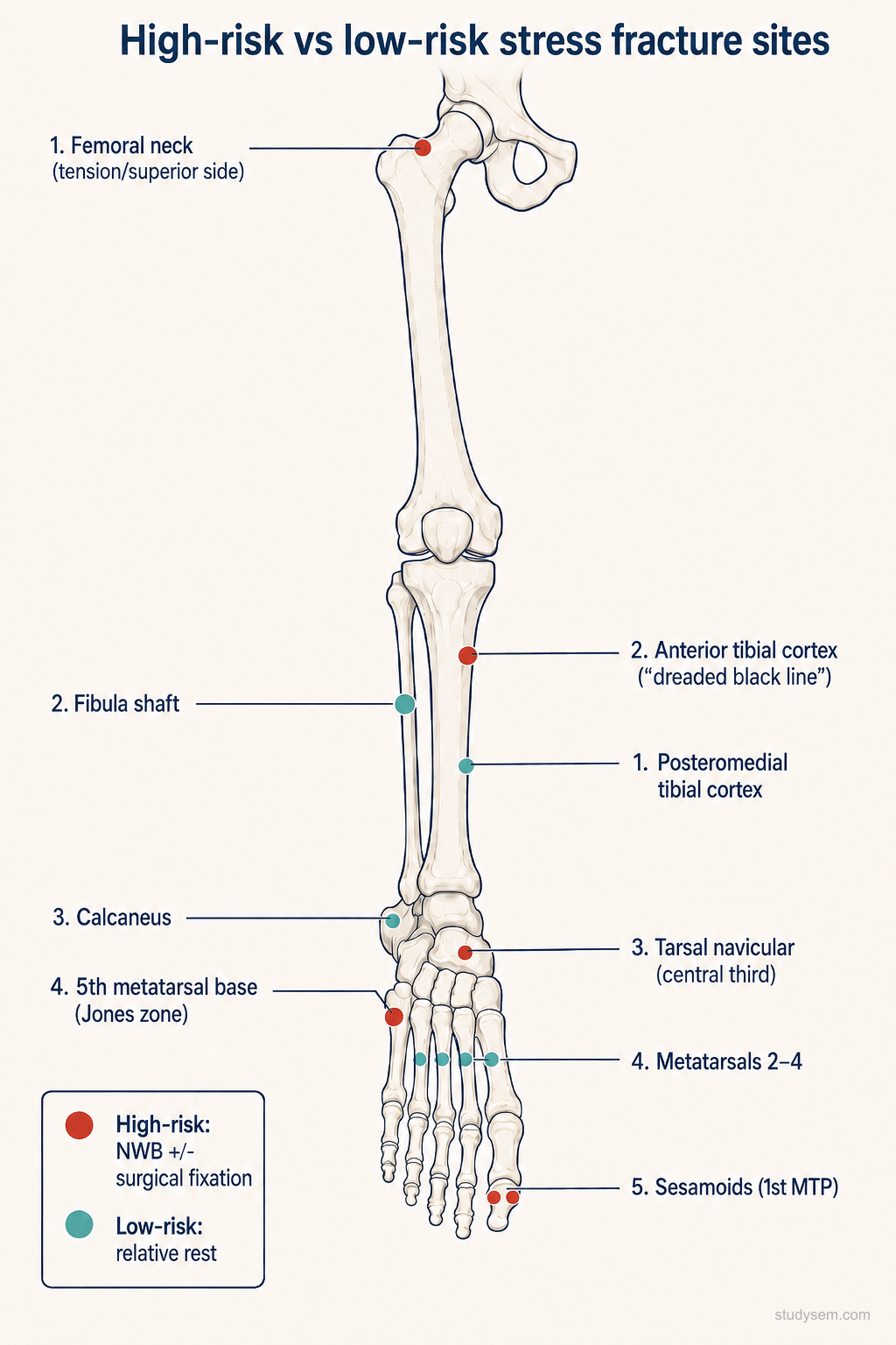 Lower limb diagram showing high-risk stress fracture sites in red (anterior tibial cortex, navicular, 5th metatarsal base, femoral neck tension side, sesamoids) and low-risk sites in teal (posteromedial tibia, fibula, calcaneus, metatarsals 2 to 4)
