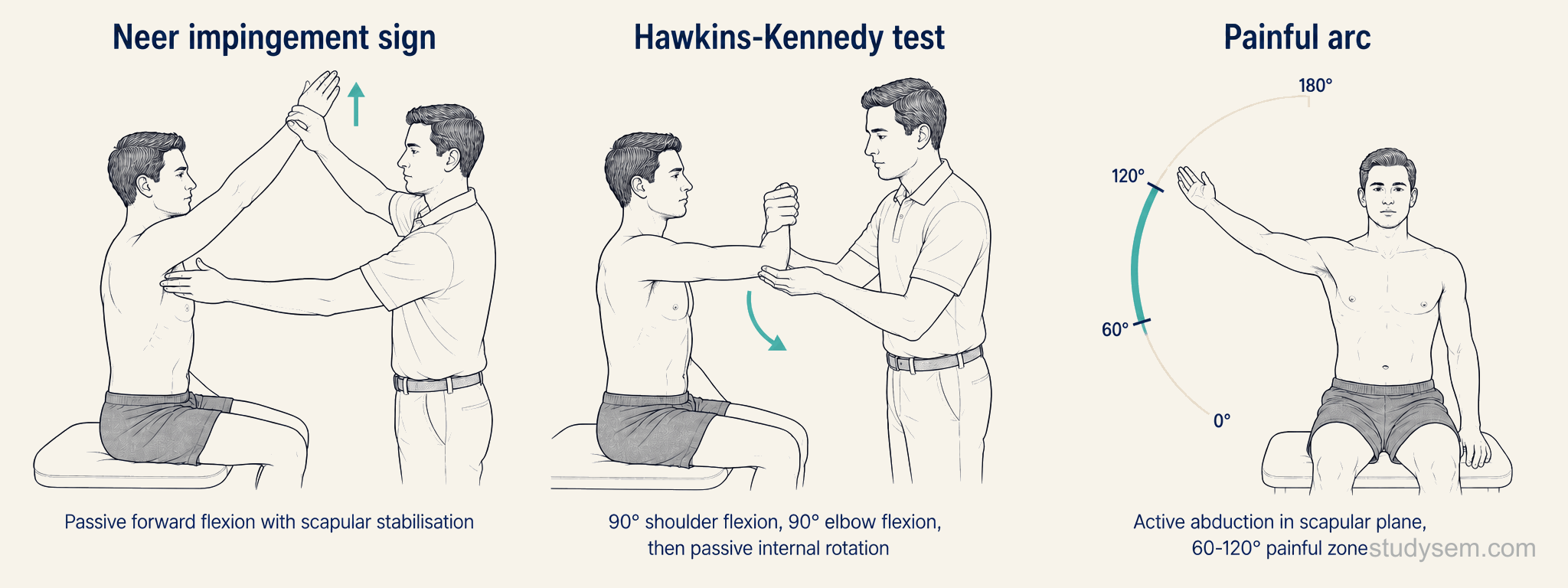 Three-panel illustration of the standard provocation tests for subacromial pain syndrome: painful arc 60-120 degrees, Neer's test, and Hawkins-Kennedy test.