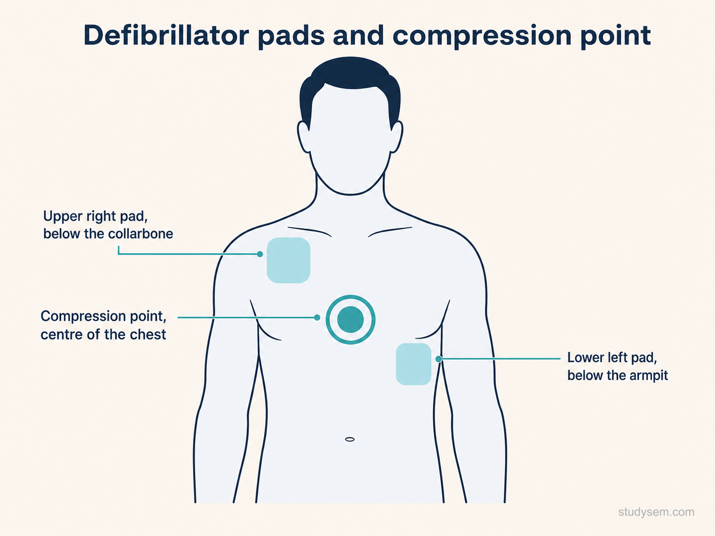 Diagram of automated external defibrillator pad placement on a bare chest, with one pad below the right collarbone and one on the left side below the armpit, and the chest compression point marked at the centre of the chest.