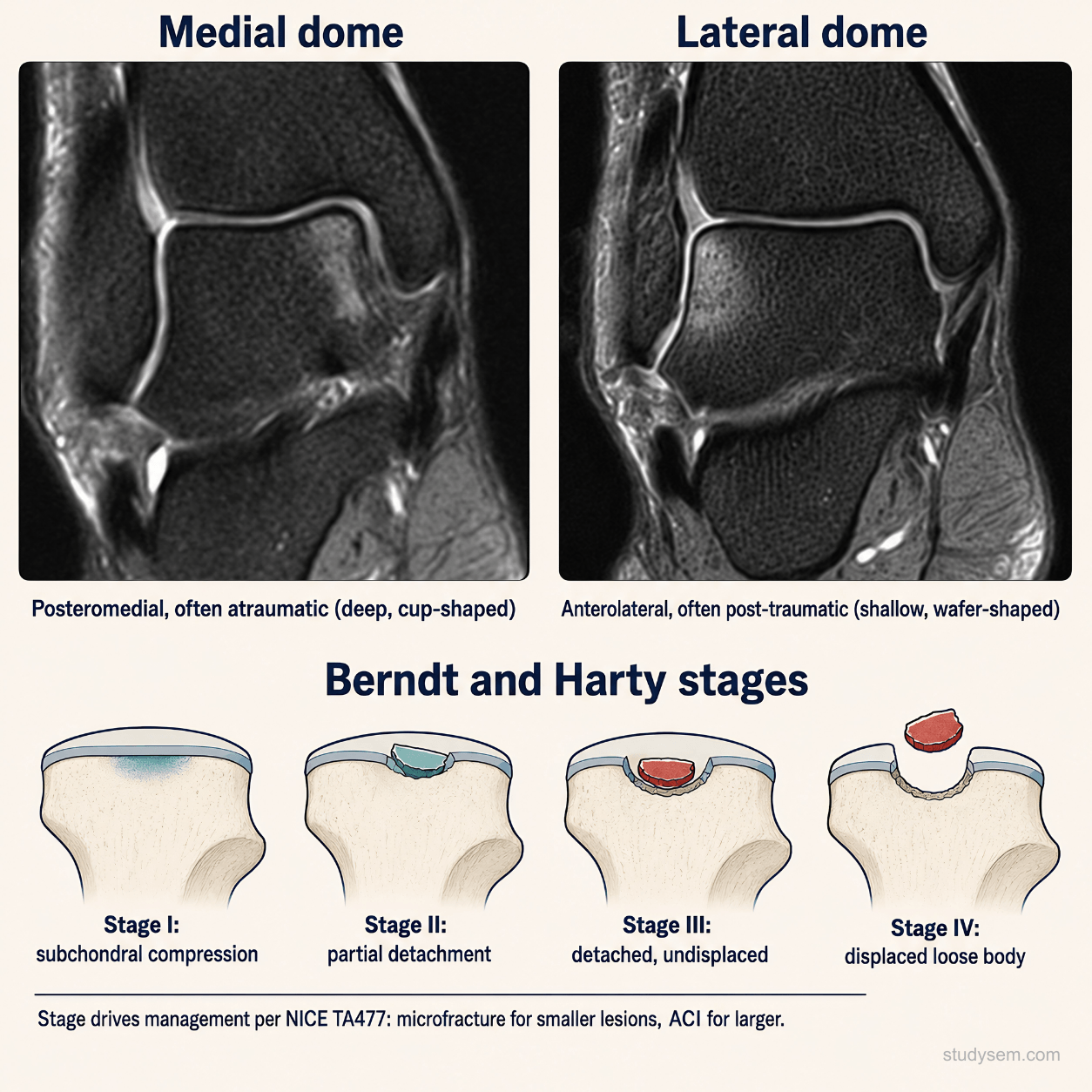 Coronal MRI of the talar dome comparing a posteromedial osteochondral lesion (deeper, cup-shaped, often atraumatic) with an anterolateral osteochondral lesion (shallower, wafer-shaped, typically post-traumatic)