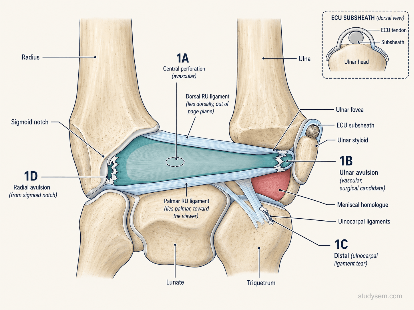 Coronal view of the TFCC showing the articular disc, dorsal and palmar radioulnar ligaments, meniscal homologue, and ECU subsheath with Palmer classification zones 1A through 1D annotated.