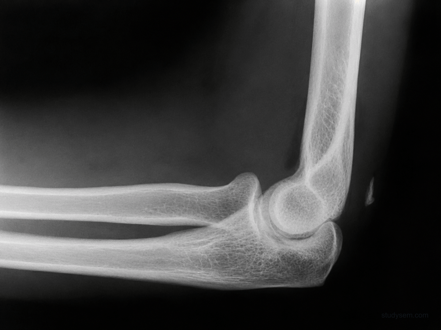 Lateral elbow radiograph appearance showing the flake sign - a small bony fragment avulsed from the olecranon by the triceps tendon.