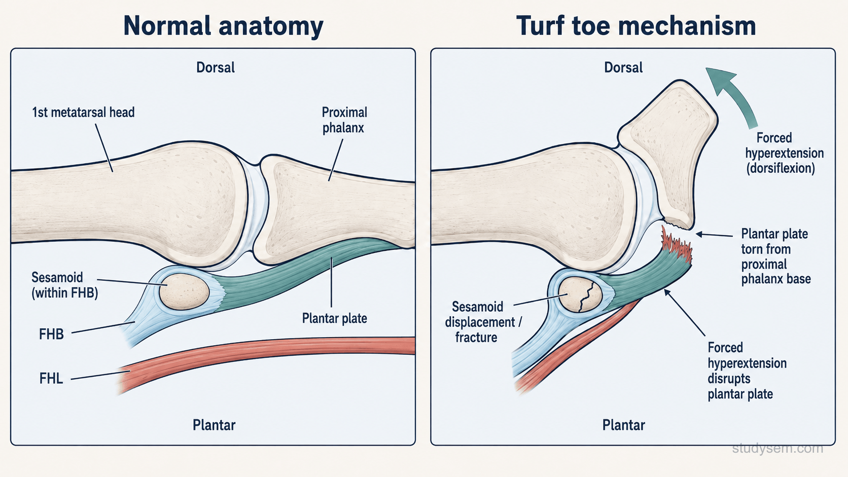 Two-panel sagittal diagram of the 1st MTP joint showing normal plantar plate anatomy with sesamoids on the left and turf toe mechanism with forced hyperextension disrupting the plantar plate on the right