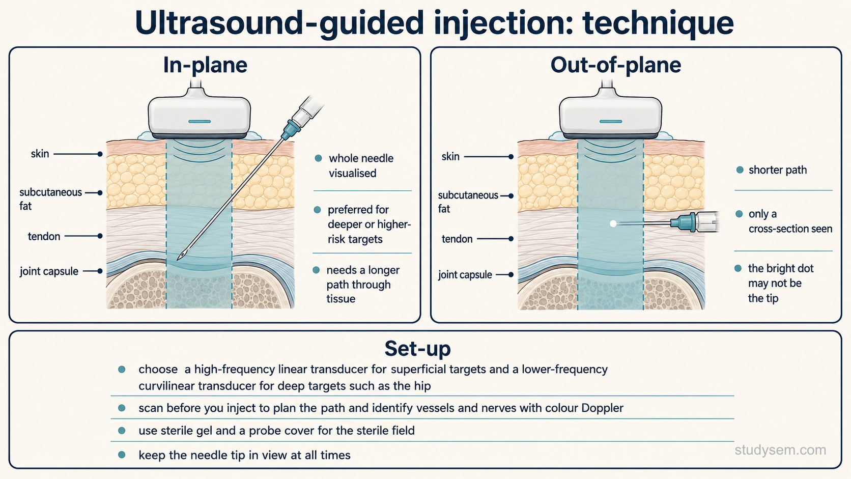 An educational figure titled 'Ultrasound-guided injection: technique'. Two clearly separated bordered panels compare needle approaches, each with an anatomically accurate cross-section through skin, subcutaneous fat and an underlying tendon and joint capsule, with a linear ultrasound transducer on the skin and the corresponding rectangular ultrasound beam shown beneath it. The left panel, in-plane, shows the needle advanced along the long axis of the transducer so that the entire needle shaft and tip are visible within the beam, labelled: facilitates continuous needle visualisation, particularly where precise tip control matters; the needle must remain within the beam to stay visible. The right panel, out-of-plane, shows the needle crossing the beam at right angles so that only a bright dot representing the needle in cross-section is visible, labelled: only a cross-section is seen; the bright dot may be the shaft rather than the tip. A note between the panels reads: neither approach is universally preferable; choose according to anatomy, a safe trajectory, the target, operator expertise and the ability to track the tip. A bordered panel headed 'set-up' lists as short bullets: choose a high-frequency linear transducer for superficial targets and a lower-frequency transducer with adequate penetration, commonly curvilinear, for deep targets such as the hip; scan before you inject to plan the path and identify vessels and nerves with colour Doppler; manage the probe, gel and needle according to the infection risk of the procedure and local policy, using a sterile probe cover and sterile gel for higher-risk procedures; and keep the needle tip in view at all times.