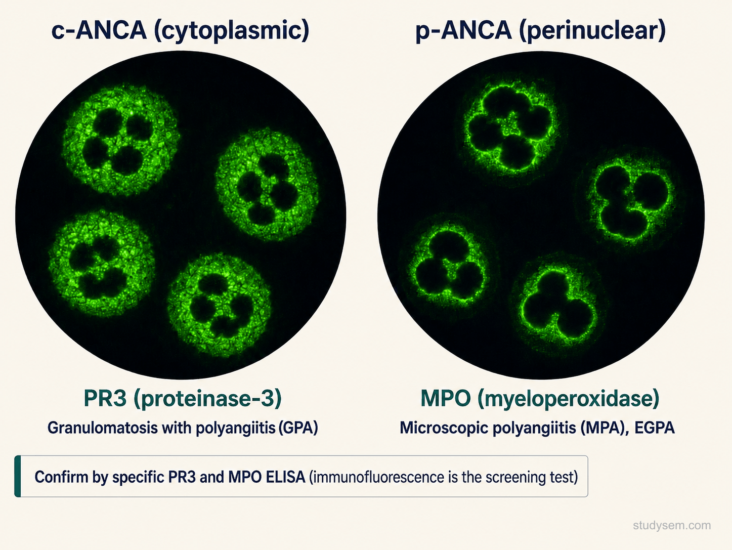 Side-by-side indirect immunofluorescence images showing c-ANCA cytoplasmic granular staining of neutrophils (anti-PR3, associated with GPA) and p-ANCA perinuclear staining (anti-MPO, associated with MPA and EGPA), with note that PR3 and MPO ELISA confirms the antibody specificity