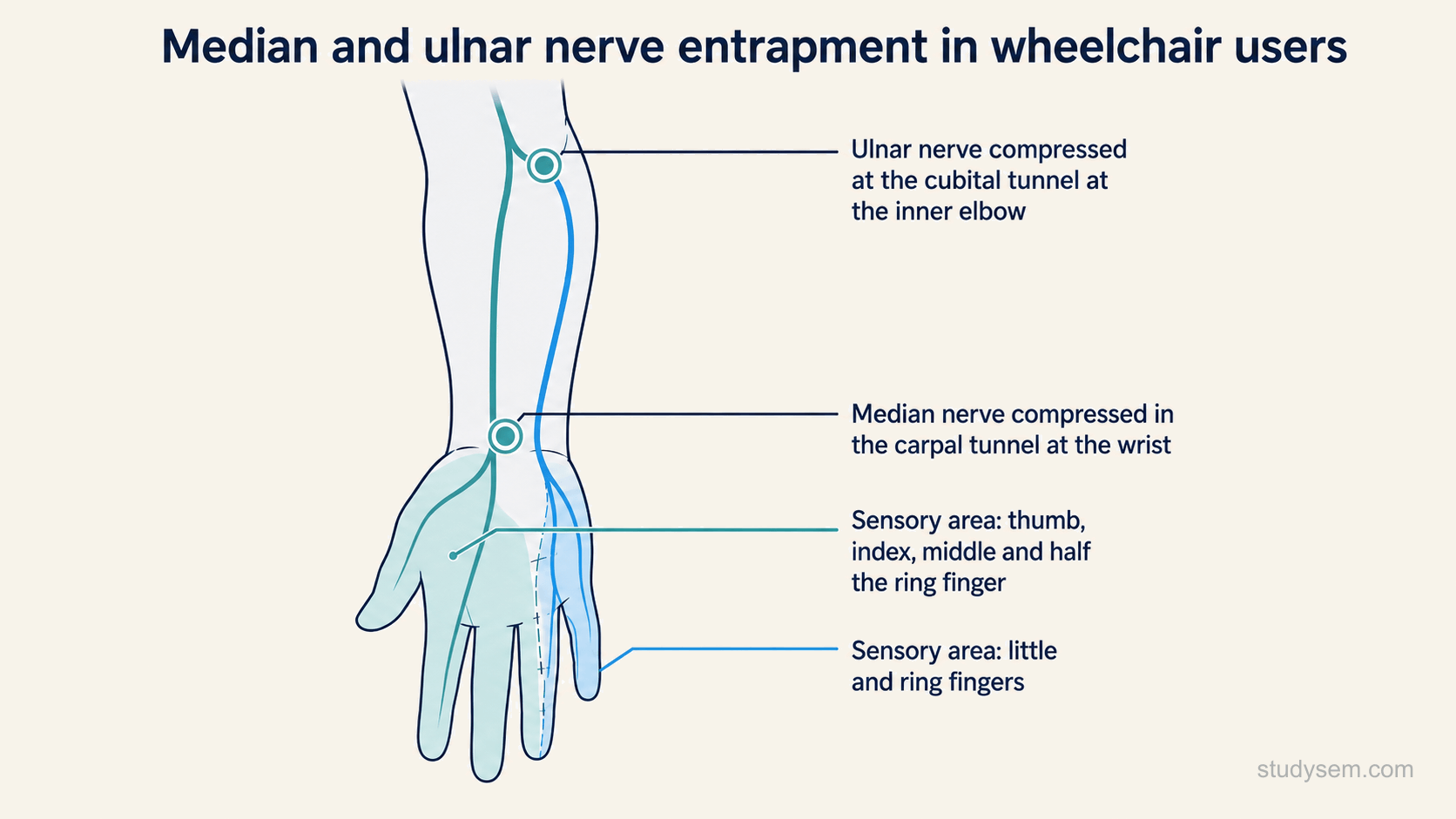 A focused diagram of the two common nerve entrapments in wheelchair users: the median nerve compressed in the carpal tunnel at the wrist with its sensory supply to the thumb, index, middle and the radial half of the ring finger, and the ulnar nerve compressed at the cubital tunnel at the elbow with its sensory supply to the little finger and the ulnar half of the ring finger.