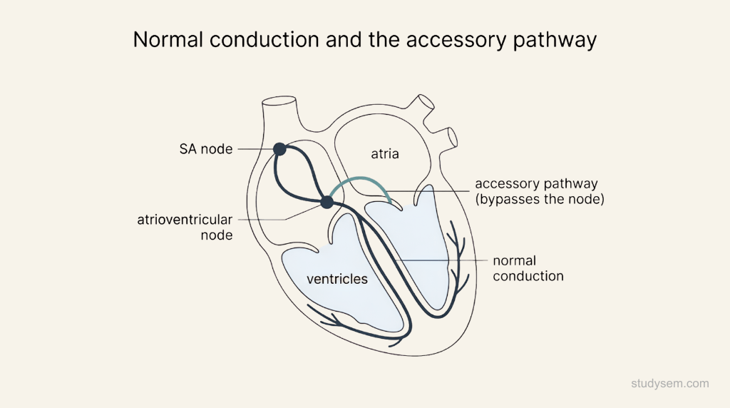 Schematic of the cardiac conduction system showing the sinoatrial node, the atrioventricular node and normal conduction to the ventricles, with a separate accessory pathway connecting atrium to ventricle and bypassing the atrioventricular node.